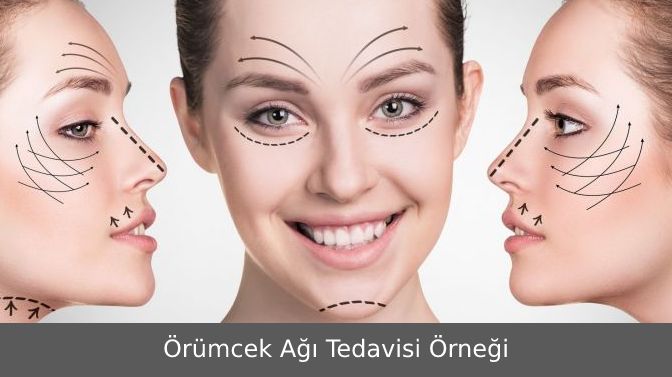 Örümcek Ağı Estetiği Ameliyatsız Yüz Germe Fiyatları İstanbul